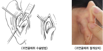 �Ϳ���ä�� �������/ �Ϳ���ä��������ó/ �Ϳ��������� �߻��� �̷��̵�