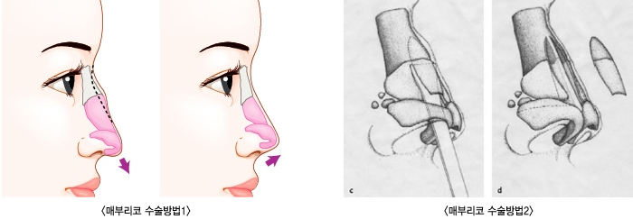 �޺θ��� �������1/�޺θ��� �������2