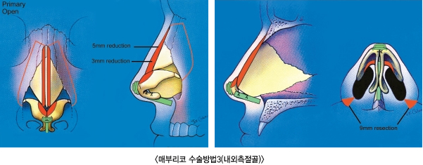 �޺θ��� �������3(����������)