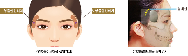 ���ڳ��̺����� ������ġ/���ڳ��̺����� ������ġ