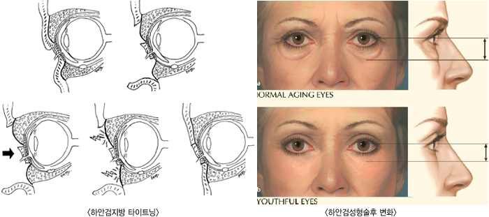 �ϾȰ� ����Ÿ��Ʈ��, �ϾȰ˼��������� ��ȭ