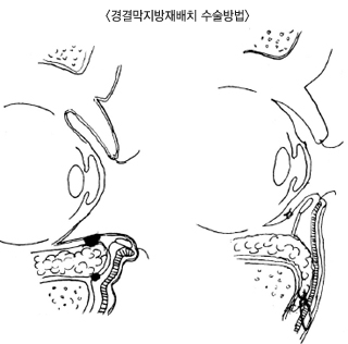 �渷�������ġ �������