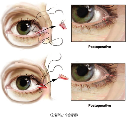�Ȱ˿ܹݼ������(�ϾȰ˴����, �ܾȰ�������), �Ȱ˿ܹݿܾȰ�������