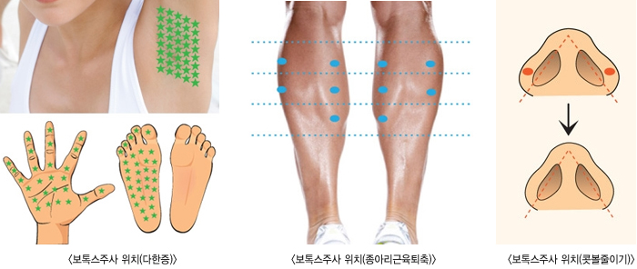 ���彺�ֻ���ġ(������,���Ƹ���������, �ຼ���̱�)